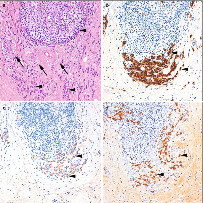 Igg4-related Orbital Disease 