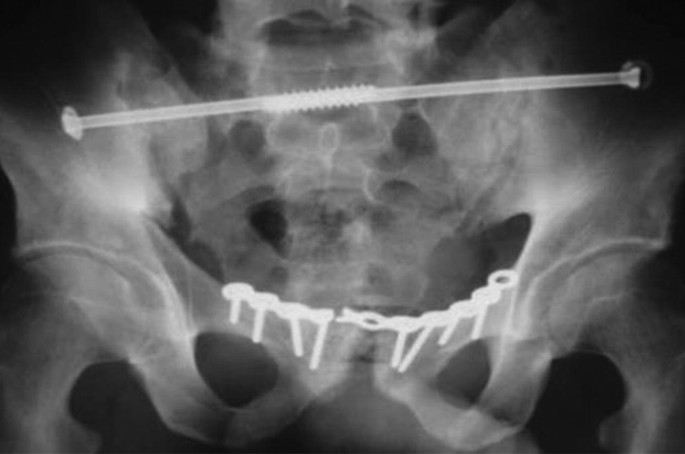 A pelvic radiograph reveals a failure of the matta plate that spans the symphysis. A long screw-like structure extends from the ilium on both sides and connects at the center.