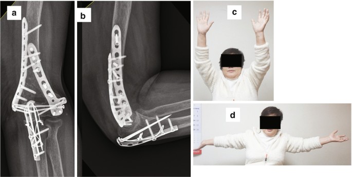 4 parts. A and B are radiographs that exhibit the left elbow fixed with an internal fixator and tension band wiring. C and D are clinical photos of a patient with arms raised up and outstretched, respectively.