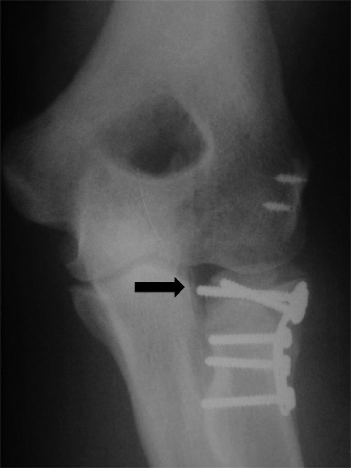 A radiograph of the foreram joint with a prosthesis secured in the proximal ulna.