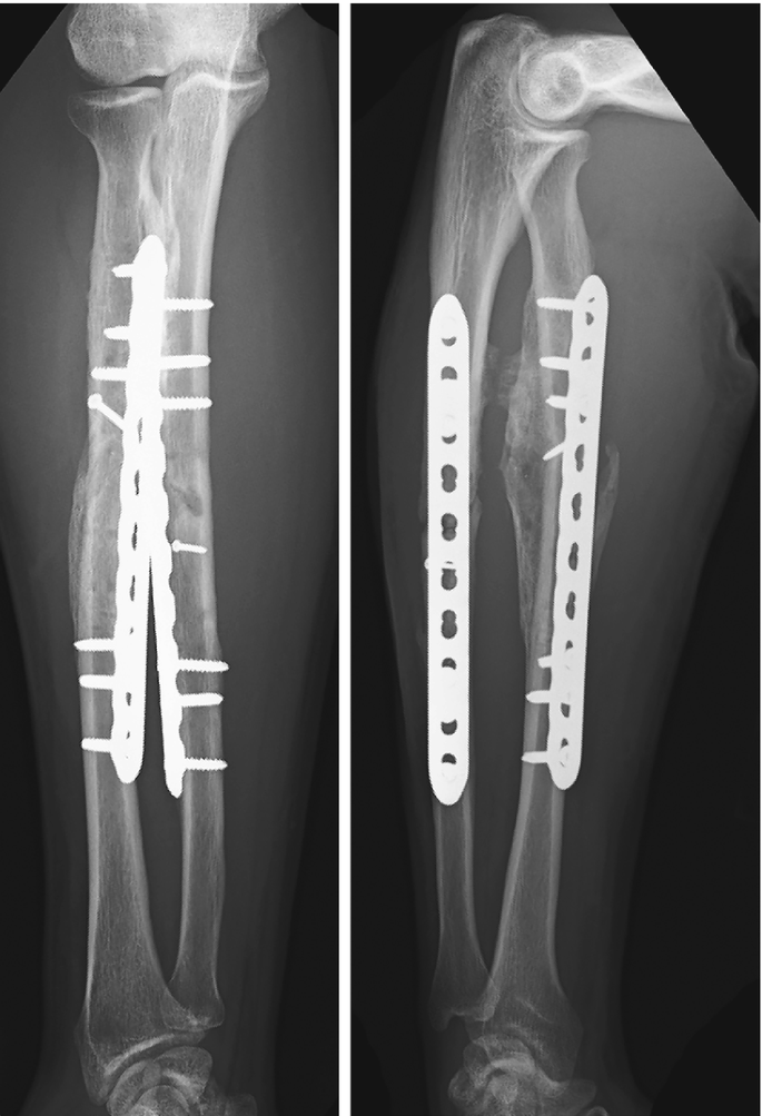 Two radiographs of an arm after surgery plates and screws are fixed for stabilization. The healing of the radial and ulnar diaphysis is evident.