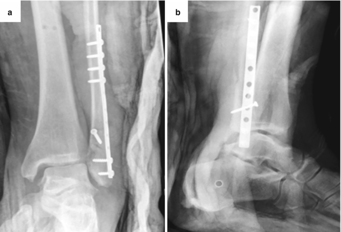 2 radiographs of the ankle joint in the anteroposterior and lateral planes. A fracture is present on the distal head of the fibula. A dense and light-shaded opacity on the ankle joint indicates swelling. A vertical metallic plate is fixed on the fractured region.