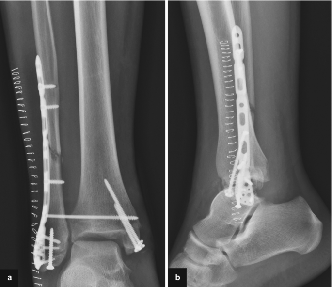 2 radiographs of the ankle. A fracture can be observed on the distal head of the fibula. A vertical plate is fixed over the fractured region. The head of the fibula is fixed onto the head of the tibia.