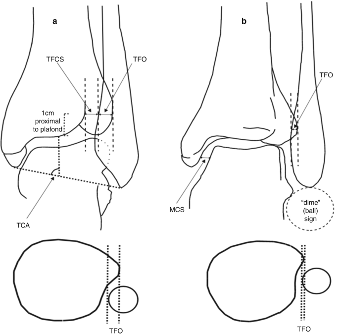 2 illustrations of the structure of the ankle joint. The parts marked in the structure are T F O, T F C S, 1 centimeter proximal to plafond, M C S, dime sign, and T C A.