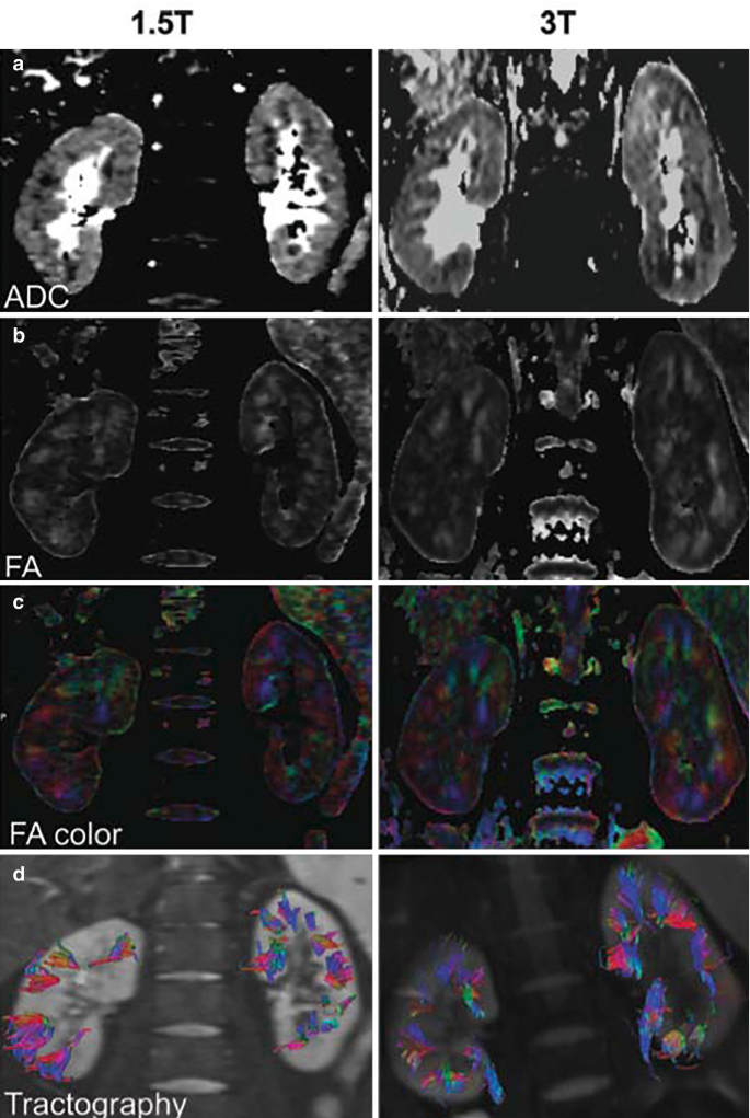 A. set of 2 A D C maps of kidney exhibits medulla at 1.5 T and 3 T. B and C set of 2 fractional anisotropy and color-coded fractional anisotropy of kidney at 1.5 and 3 T. D. D. set of 2 tractographies of the kidney.