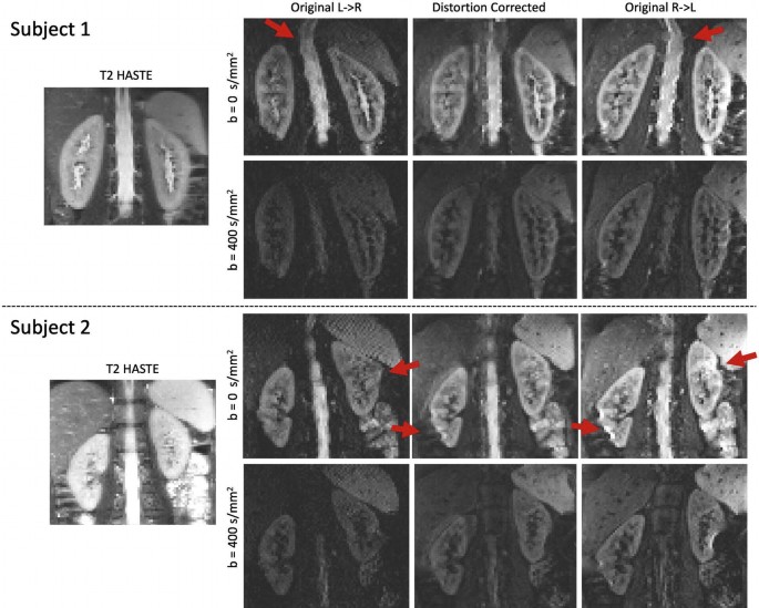 14 M R I scan images of the kidney. Subjects 1 and 2 of T 2 haste on the left, 12 M R I scan image of the kidney at original l greater than R, distortion corrected, and original right greater than L are arranged in 3 columns. The arrows indicate areas with distortion.