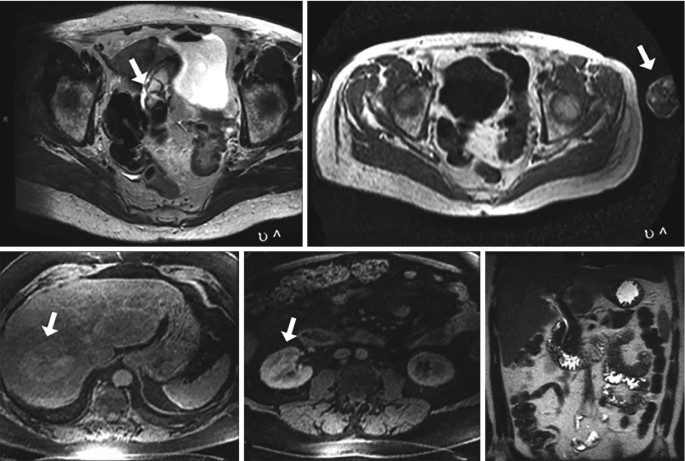 5 M R I of the axial views of the abdomen have an arrow marking the wraparound artifacts.