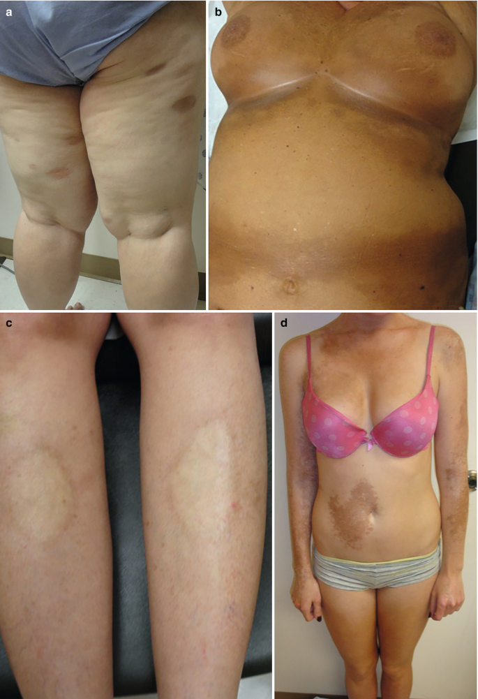 6 photographs. 1. Dark spots on the posterior legs. 2. Hyperpigmentation on the chest and abdomen. 3. Light spots on the legs. 4. Dark lesions on the chest, hands, and abdomen. 5. Sclerosis in the whole body surface. 6. Sclerosis of the hand sparing the fingertips.