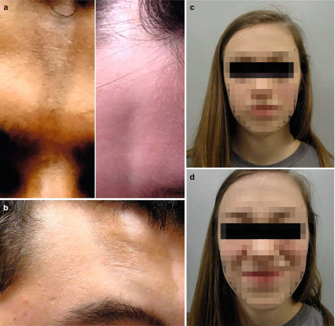 6 photographs. 1 and 2. Dyspigmented linear plaques on the forehead. 3 and 4. A face of a person with different facial expression. 5 and 6. Lesions on the neck, abdomen, forehead, and the chin.