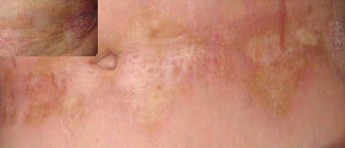 A photograph and a magnified inset of sclerotic lesions in the abdomen region of a patient. The abdomen illustrates hypopigmentation and wrinkled skin.