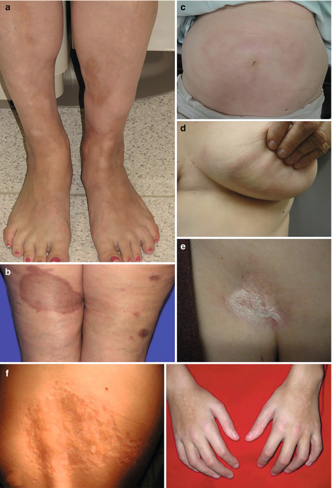 9 photographs. 1 and 2. Morphea on the legs with dark spots and cobblestone appearance. 3 and 4. Lesions on the abdomen and breast. 5. Lesion with a lighter shade. 6. Dark patches on the back of a patient. 7, 8, and 9. Limb length abnormality and lesions on the crossing joints of the hand.