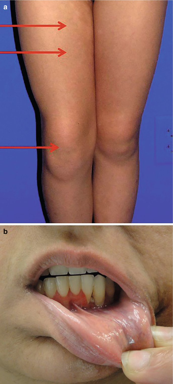 2 photographs. 1. Swollen right knee and morphea affected upper regions of the right leg. 2. Gingival changes in the inner region of the mouth.