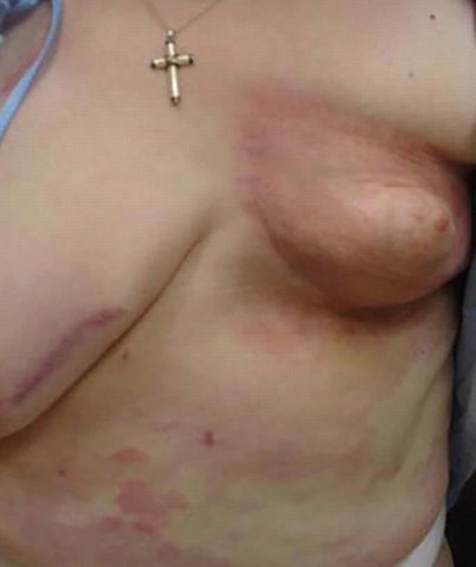 A photograph of the chest and abdomen of a patient. It presents morphea on the breast. The trunk presents lesions in a darker shade.