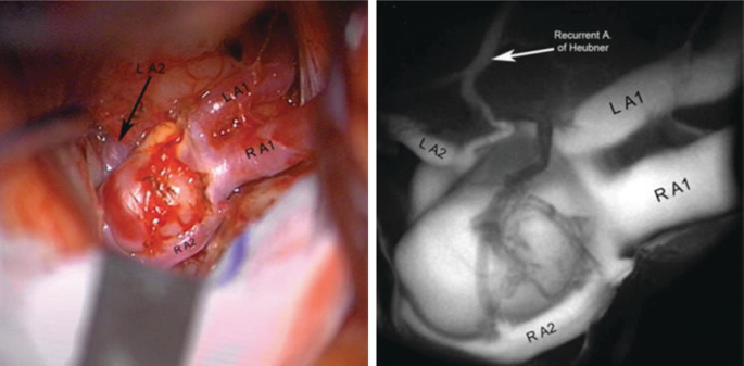 2 angiographies of the Huebner arteries. Both the photos are labeled as L A 2, L A 1, R A 1, and R A 2.