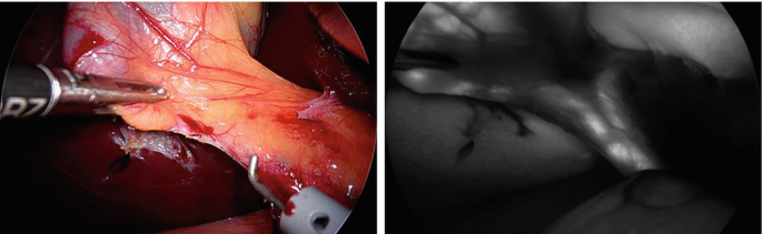 2 photographs. The left photo exhibits leaf-like flesh held with a medical metal tool. The right photo exhibits a funnel-shaped organ.