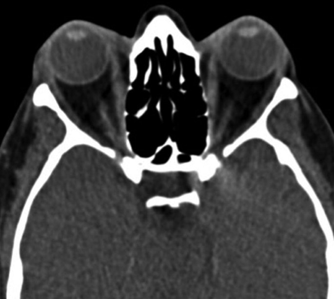 An axial view C T scan of the eyes reveals the enlargement of the orbital tissues.