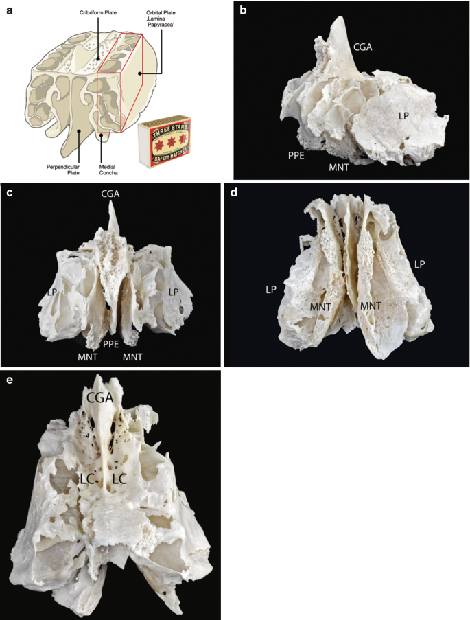 5-part images. A. A graphical illustration of the ethmoid bone in the left anterolateral view exhibits the cribriform plate, orbital plate, perpendicular plate, and medial concha. B to E. Four anatomical photos of the ethmoid bone are labeled with C G A, P P E, M N T, L P, and L C.