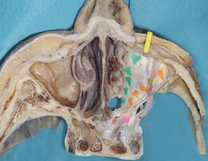 An anatomical photo of the axial section of the maxillary sinus exhibits the tube inserted below the periorbital region. The perforators connecting intraperiorbital vessels on the right are indicated with arrowheads.