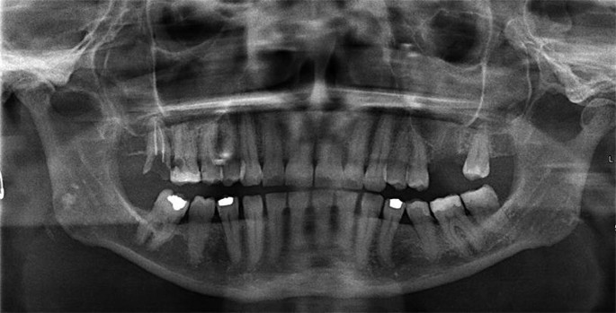 An extraoral X-ray scan depicts the left maxillary sinus.