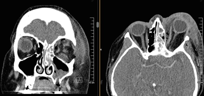 2 coronal and axial view C T scans of the patient. Both scans depict the swelling on the left side of the face.