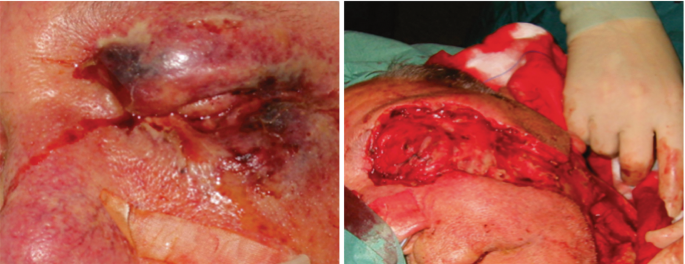 2 intraoperative photographs of the patient with P O N F of the left part of the face.