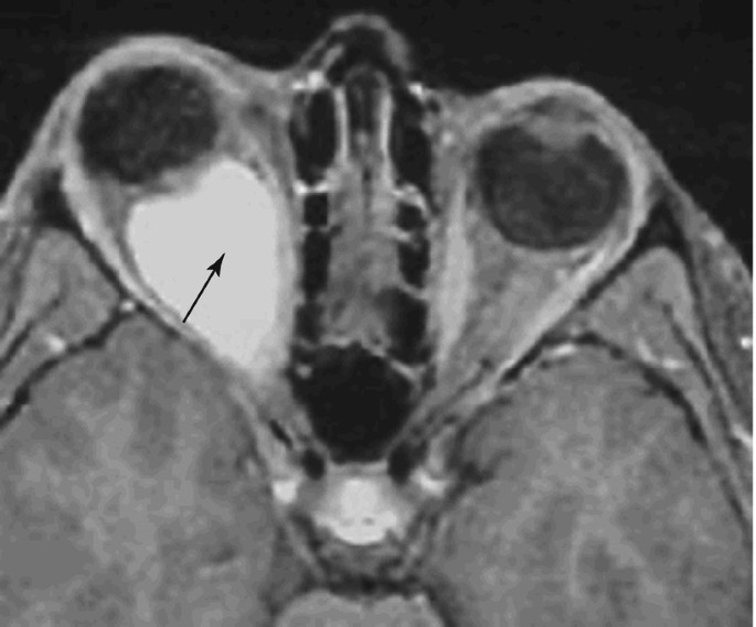 An axial view M R I scan reveals pilocytic astrocytomas. An arrow marks the enlargement of the bone tissue in the left eye.