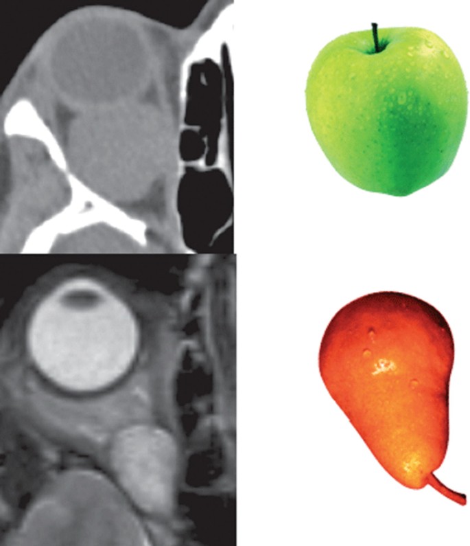 2 axial view scans. The upper is a C T scan that exhibits the shape of the orbital cavernous hemangiomas, resembling an apple. The bottom is an M R I scan that exhibits the shape of the hemangiomas, resembling a pear.