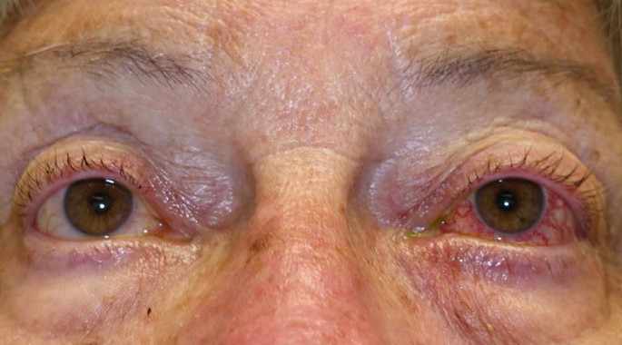 A close-up photograph of the eyes of a patient with a red cornea in the left eye due to the blood flow in the opposite direction.