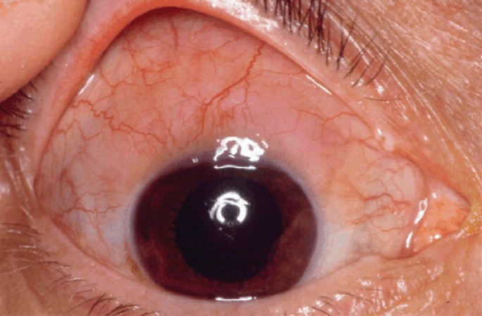A close-up photograph of the right eye with red cornea. It depicts a lesion in the interior orbit known as N H L.