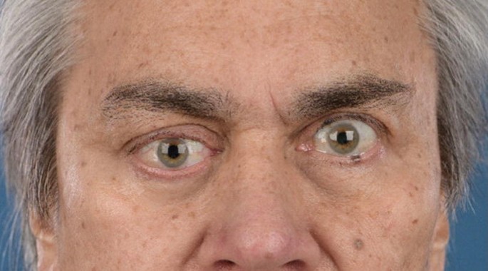 A close-up photograph of the eyes of a patient with Pleiomorphic adenoma. It displays the location of the right eye a little lower than the left eye.