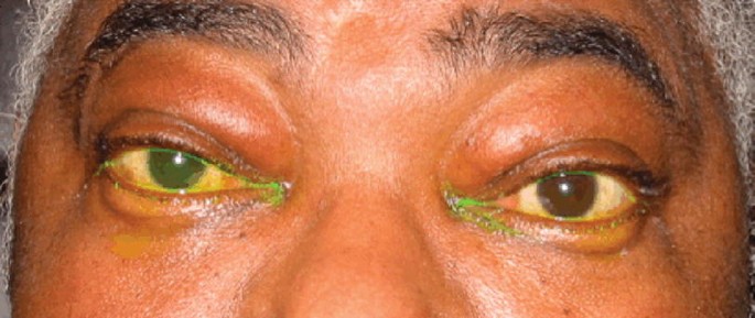 A close-up photograph of the eyes of a patient with affected lacrimal glands. It marks the discoloration of the inner corners of the eyes.