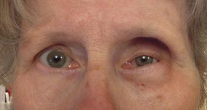 A close-up photograph of the eyes of a female patient. It displays an abnormality in the left eye. The left eye is located inwards as compared to the right eye, resulting in a small opening of the lid.