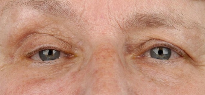 A close-up photograph of the eyes of a female patient with contracted rectus muscle and impaired motility.