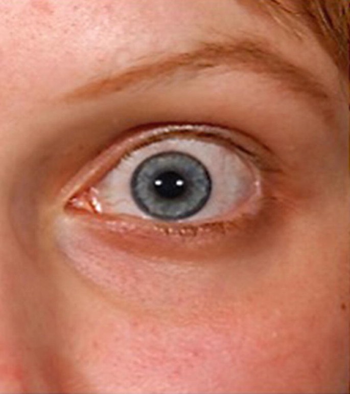 A close-up view of the left eye of a patient with upper eyelid retraction.