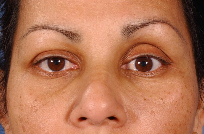 A close-up view of the eyes of a patient with malposition of the upper left eyelid.