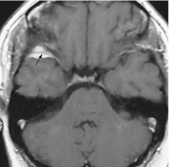 An axial view M R I scan of the head. An arrow marks the orbital tumor under the left eye.