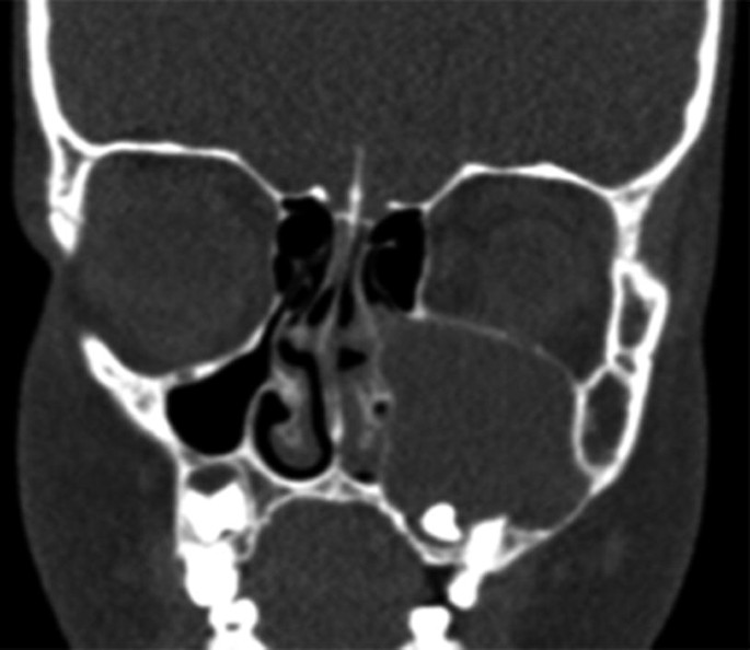 A preoperative coronal view C T scan of the skull represents the follicular cyst on the left maxilla.