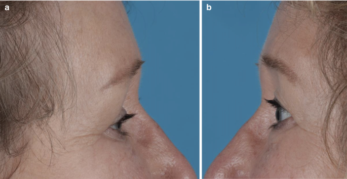 2 lateral photographs of a patient with a silent sinus compare the position of her eyes.