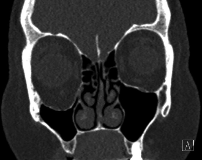 A coronal view C T scan of the skull of a patient with silent sinus to compare the positions of eyes.