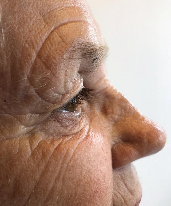 A lateral view photograph of a female patient with sinus swelling on the left side of the face.