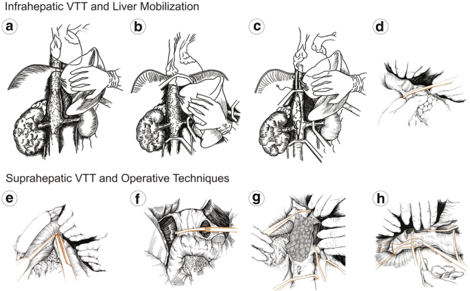 8 surgical illustrations exhibit infrahepatic V T T and liver mobilization, as well as suprahepatic V T T and operative techniques.