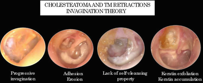 Pathogenesis of Chronic Otitis Media