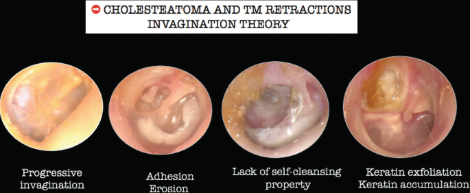 A chart of the cholesteatoma and T M retractions invagination theory. It includes progressive invagination, adhesion erosion, lack of self-cleaning properties, and keratin exfoliation keratin accumulation.