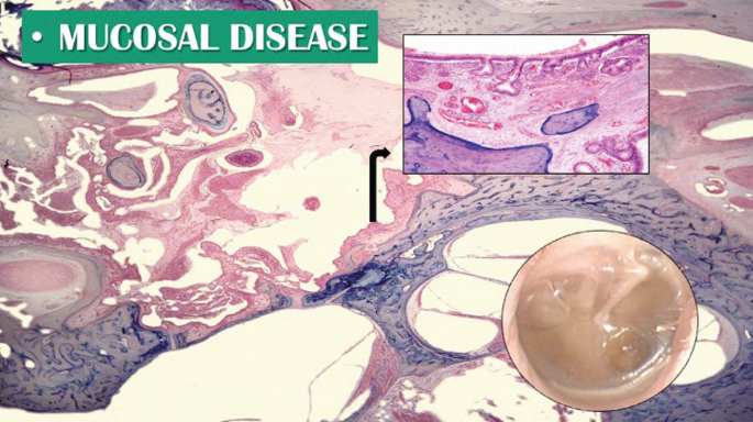 A histologic view of the middle ear with thickened mucosa and subepithelial space.