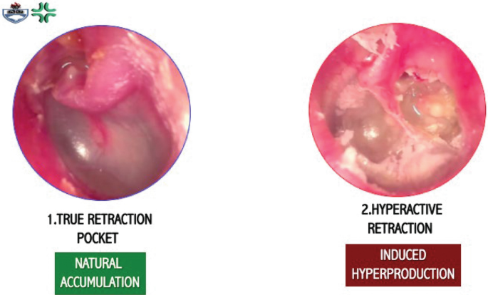 Two otoscopic views highlight the mechanisms causing instability in a retracted T M. They are labeled as follows. 1, true retraction pocket leading to natural accumulation, and 2, hyperactive retraction resulting in induced hyperproduction.