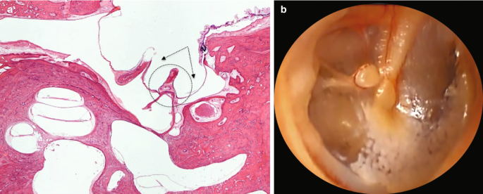 A photomicrograph and an otoscopic view of human temporal bone. They highlight the retraction of the tympanic membrane.