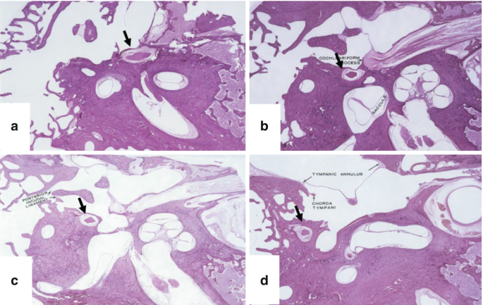 Four photomicrographs of the temporal bone sections are labeled A to D. They highlight the facial nerve inside the fallopian canal.