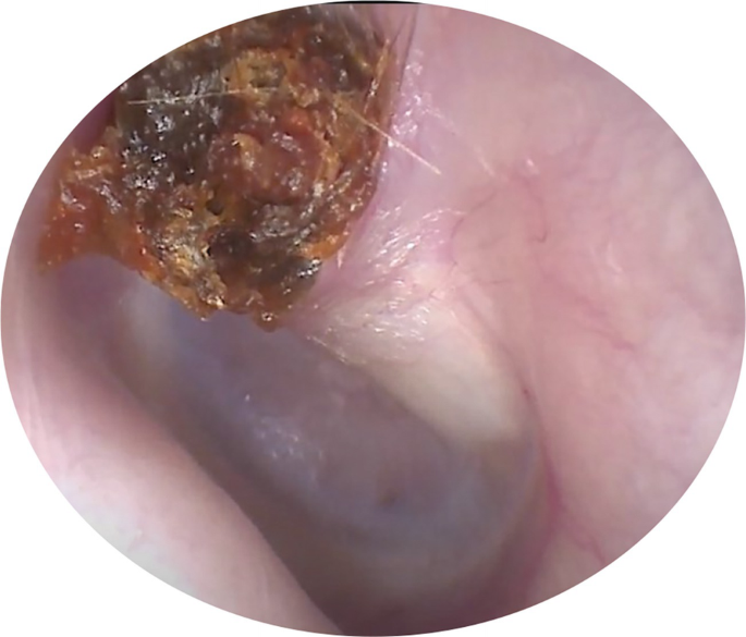 An otoscopic view of the crust in the fundus of the external auditory nerve.