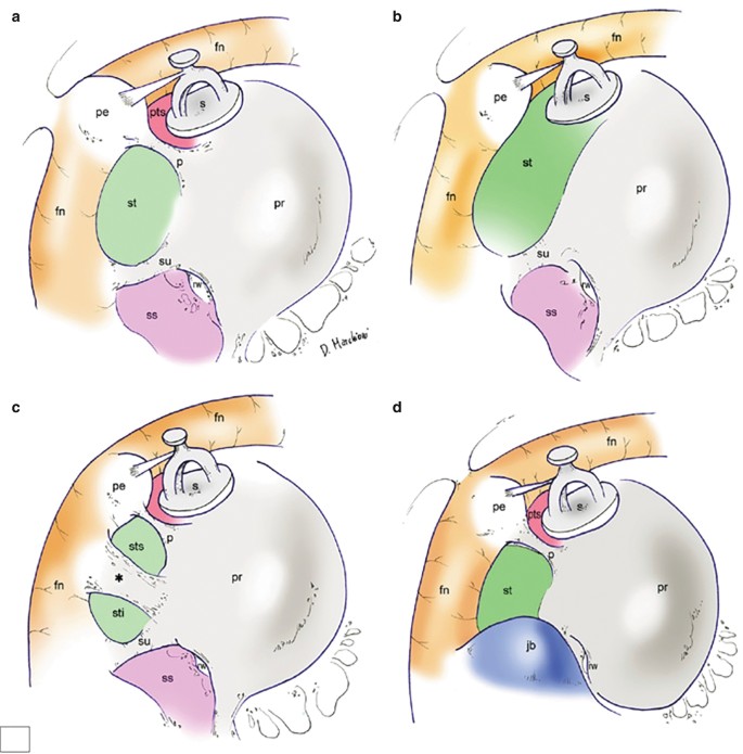 4 illustrations exhibit a facial nerve under which a round shaped structure is labeled p r along with s t, s s, p t s, p e, and j b.