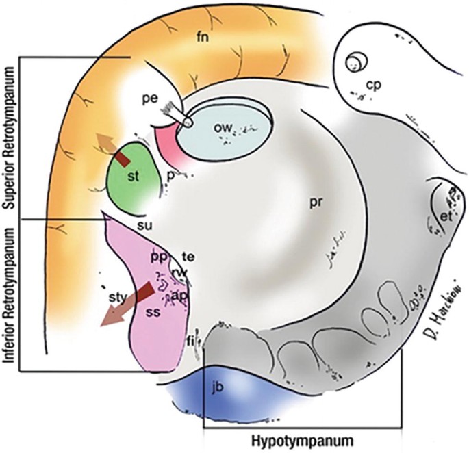 An illustration of the internal ear exhibits the labels hypotympanum at the bottom, inferior retro tympanum at the bottom left, and superior retro tympanum at the top left.